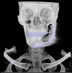 Mandibular Reconstruction - CTisus CT Scan