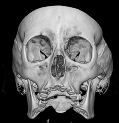 Orbital Trauma - CTisus CT Scan