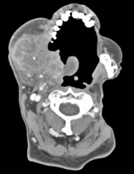 Recurrent Head and Neck Tumor - CTisus CT Scan