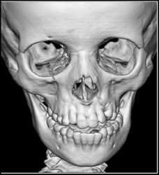 Orbital Trauma - CTisus CT Scan