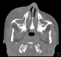 Orbital Trauma - CTisus CT Scan