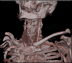 Carotid Artery Disease - CTisus CT Scan