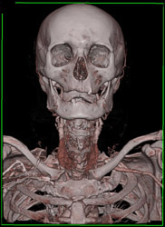 Volume Rendering With Opaque Technique - CTisus CT Scan