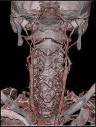 Carotid Artery Diesase - CTisus CT Scan