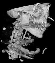 Artifacts Off Fillings - CTisus CT Scan