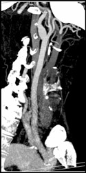 Normal Carotid Artery - CTisus CT Scan