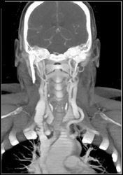 CTA Post Stab Wound - CTisus CT Scan