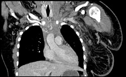 Infiltration of Mediastinum With Left Jugular Vein Thrombosis (JVT) - CTisus CT Scan