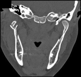 Mandibular Fracture - CTisus CT Scan