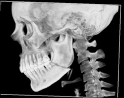 Mandibular Fracture -same Case as Previous 3 Cases - CTisus CT Scan