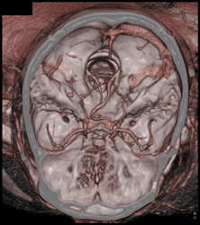 Normal Circle of Willis - CTisus CT Scan