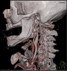 Mildly Dilated Internal Carotid Artery - CTisus CT Scan