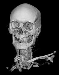 Facial Swelling - CTisus CT Scan