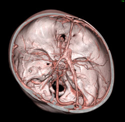 Twins Joined at the Calvarium - CTisus CT Scan