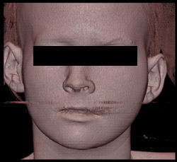 Orbital Fracture - CTisus CT Scan