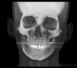 Orbital Fracture - CTisus CT Scan