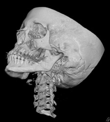 Normal Sutures - CTisus CT Scan