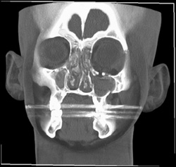 Orbital Fracture - CTisus CT Scan