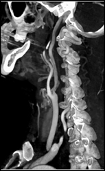 Carotid Stenosis - CTisus CT Scan