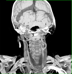 Circle of Willis - CTisus CT Scan