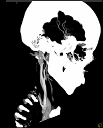 Normal Carotid Artery - CTisus CT Scan