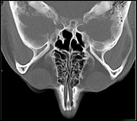 Normal Carotid Canal - CTisus CT Scan