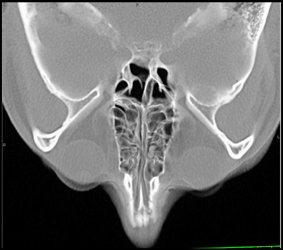 Normal Sinuses - CTisus CT Scan