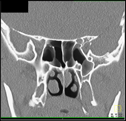 Thickened Mucosa - CTisus CT Scan