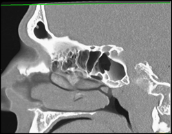 Small Polyps in Sinus - CTisus CT Scan