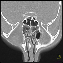 Sinus - CTisus CT Scan