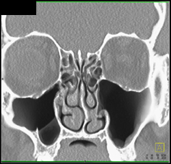 64 Slice of the Sinuses - CTisus CT Scan