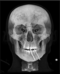 Orbital Fracture - CTisus CT Scan