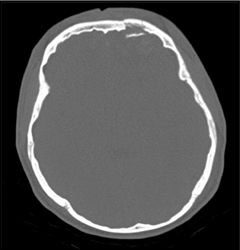 Orbital Fracture - CTisus CT Scan