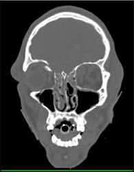 Orbital Fracture - CTisus CT Scan