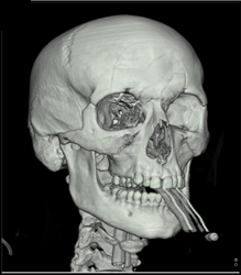 Orbital Fracture - CTisus CT Scan