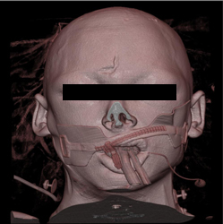 Orbital Fracture - CTisus CT Scan