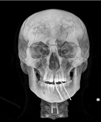 Orbital Fracture - CTisus CT Scan