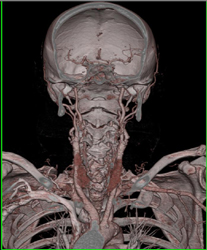 Carotid Artery Stenosis - CTisus CT Scan