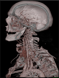 Carotid Artery Stenosis - CTisus CT Scan