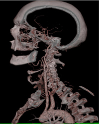 Carotid Artery Stenosis - CTisus CT Scan