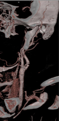 Carotid Artery Stenosis - CTisus CT Scan