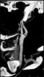 Carotid Artery Stenosis - CTisus CT Scan