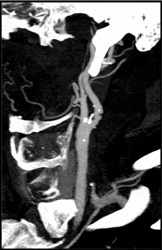 Carotid Artery Stenosis - CTisus CT Scan