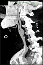 Carotid Artery Aneurysm - CTisus CT Scan