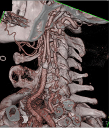 Carotid Stenosis and Plaque - CTisus CT Scan