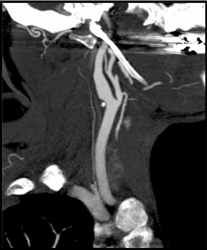 Carotid Stenosis - CTisus CT Scan