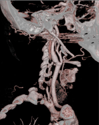 Carotid Stenosis - CTisus CT Scan