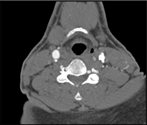 Carotid Stenosis - CTisus CT Scan