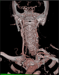 Carotid Stenosis - CTisus CT Scan