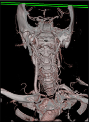 Carotid Stenosis - CTisus CT Scan